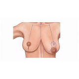 mamoplastia de elevação preço São Paulo