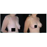 mamoplastia de elevação Taboão da Serra