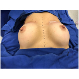 mamoplastia de levantamento Vila Andrade