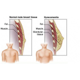 Mamoplastia para Homem