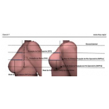 Mamoplastia Redutora com Silicone