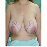 Mamoplastia Redutora