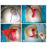 mamoplastia redutora com silicone Taboão da Serra