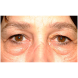 onde encontro blefaroplastia bolsa de gordura Morumbi