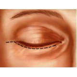 onde encontro blefaroplastia inferior São Paulo