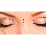 onde encontro blefaroplastia superior Taboão da Serra