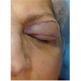 onde encontro cirurgia de blefaroplastia superior Vila Andrade