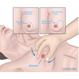 onde encontro cirurgia ginecomastia Santo Amaro
