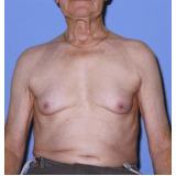 onde encontro ginecomastia masculina Morumbi