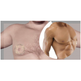 onde encontro ginecomastia Vila Andrade