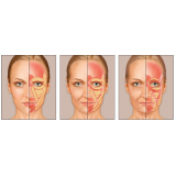 onde encontro preenchimento facial com gordura Morumbi