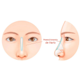 onde encontro preenchimento nariz Vila Andrade