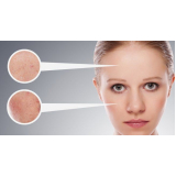 onde encontro tratamento de pele a laser Morumbi