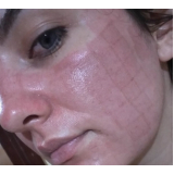 onde encontro tratamento de pele laser co2 fracionado São Paulo