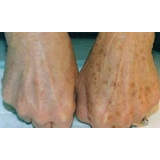 onde encontro tratamento de pele para manchas Taboão da Serra