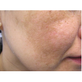 onde encontro tratamento de pele para tirar manchas São Paulo