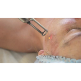 onde encontro tratamento para pele do rosto Vila Andrade