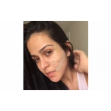 preenchimento facial com gordura Morumbi