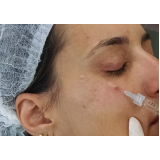 preenchimento na área dos olhos preço Taboão da Serra