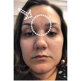 preenchimento na testa preço Vila Andrade