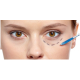 preenchimento nas olheiras preço Morumbi