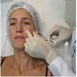 preenchimento nas olheiras São Paulo