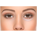 preenchimento para olheiras Morumbi