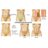 quanto custa abdominoplastia com lipo Vila Andrade