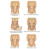 quanto custa abdominoplastia e mamoplastia Taboão da Serra