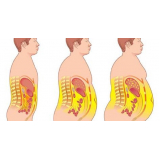 quanto custa abdominoplastia masculina Taboão da Serra