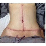 quanto custa abdominoplastia para gordos São Paulo