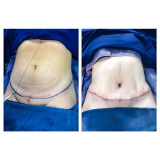 quanto custa abdominoplastia para reduzir medidas Taboão da Serra