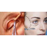 quanto custa blefaroplastia superior Santo Amaro