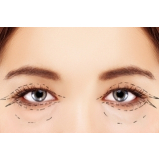 quanto custa cirurgia blefaroplastia inferior Santo Amaro