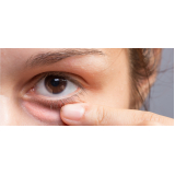 quanto custa cirurgia de blefaroplastia inferior Morumbi