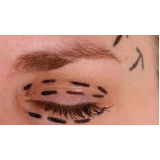 quanto custa cirurgia de blefaroplastia superior Santo Amaro