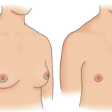 quanto custa cirurgia ginecomastia grau 1 Taboão da Serra