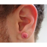 quanto custa cirurgia para queloide na orelha Morumbi
