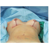 quanto custa cirurgia plástica mamoplastia São Paulo