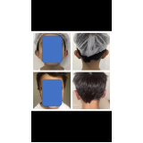 quanto custa cirurgia plástica orelha São Paulo