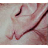 quanto custa cirurgia plástica para rasgo na orelha Vila Andrade