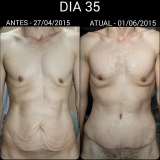 quanto custa cirurgia plástica pós bariátrica São Paulo