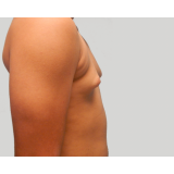 quanto custa ginecomastia grau 1 Taboão da Serra