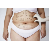 quanto custa lipoaspiração abdominal Vila Andrade