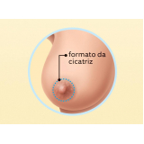 quanto custa mamoplastia aureola Taboão da Serra