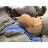 quanto custa mamoplastia bilateral São Paulo