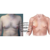 quanto custa mamoplastia para homem Morumbi