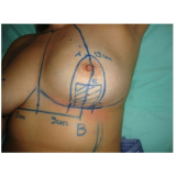 quanto custa mamoplastia redutora Morumbi