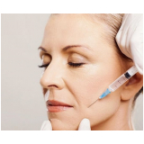 quanto custa preenchimento bigode chines São Paulo