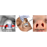 quanto custa rinoplastia para homens São Paulo